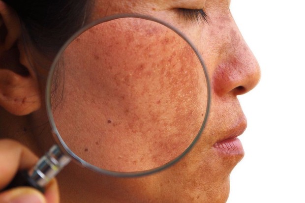 foto: Kanker Kulit/freepik.com foto: Kanker Kulit/freepik.com
