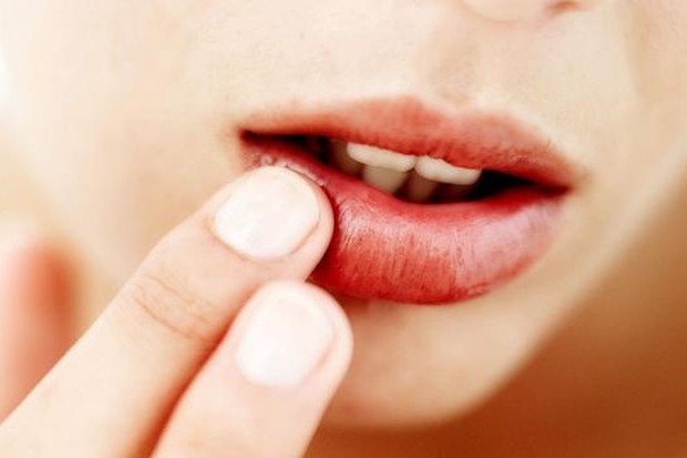 foto: Pembengkakan Bibir/freepik.com foto: Pembengkakan Bibir/freepik.com