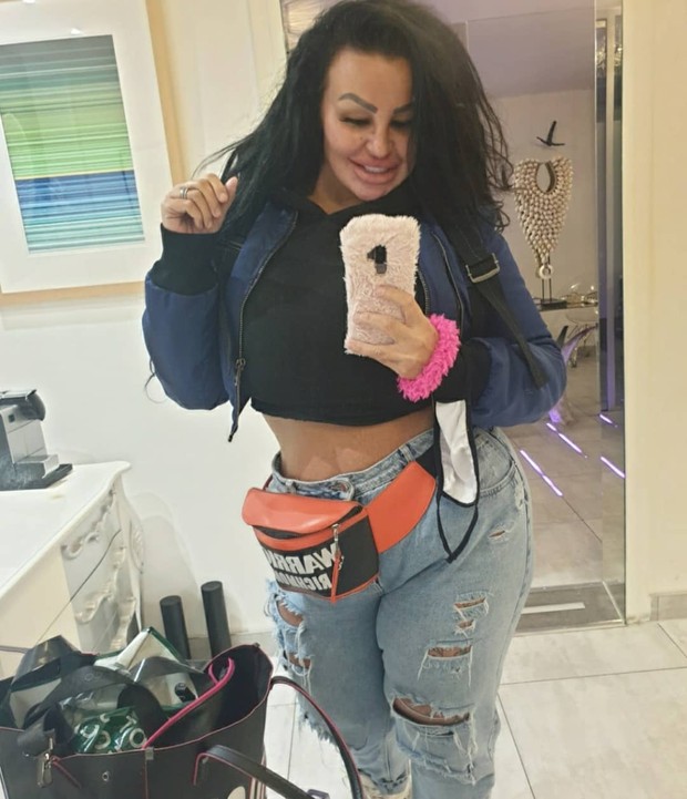 Penampilan setelah operasi plastik/Instagram.com/krystinajamieson Penampilan setelah operasi plastik