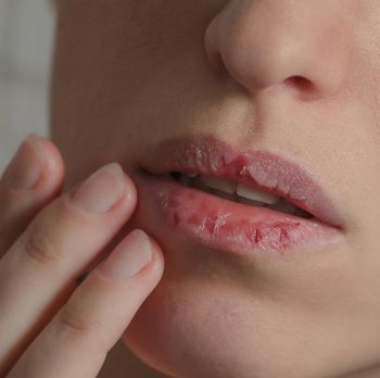 Dermatillomania skin picking. Woman has bad habit to pick her lips. Harmful addiction based on anxiety stress and dry lips. Excoriation disorder. Sick cracked damaged tissue.