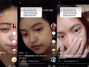 Viral Kista di Mata Disangka Bintitan, Tak Tahunya Kalazion dan Harus Operasi Viral Kista di Mata Disangka Bintitan, Tak Tahunya Kalazion dan Harus Operasi