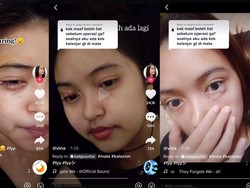 Viral Kista di Mata Disangka Bintitan, Tak Tahunya Kalazion dan Harus Operasi