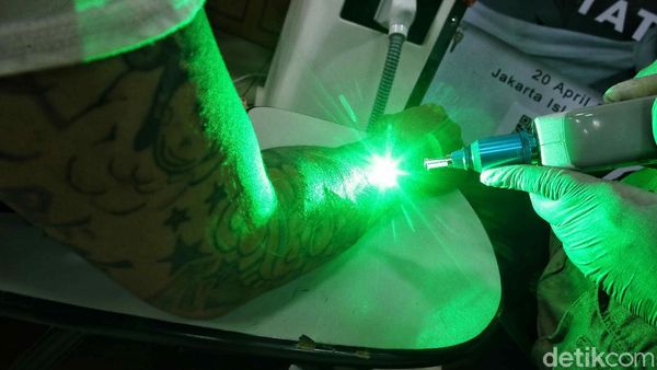 Layanan Hapus Tato Gratis di Bulan Suci Ramadhan