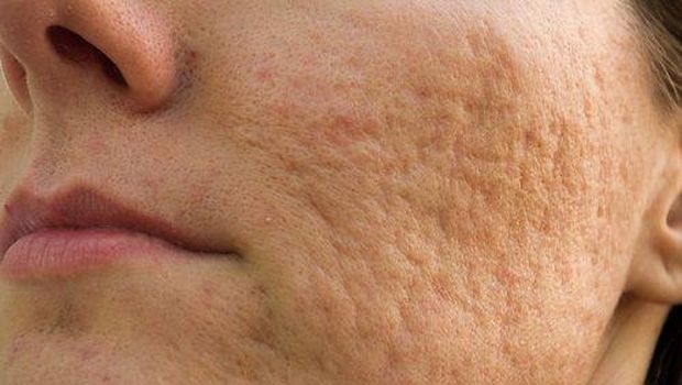 Ilustrasi bopeng di wajah Foto:pinterest/obatjerawatampuh