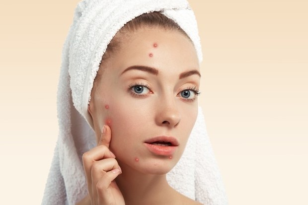 Timbulnya jerawat bukan hanya terjadi karena kesalahan skincare saja lho! Tapi ini juga tanda bahwa ususmu kotor.