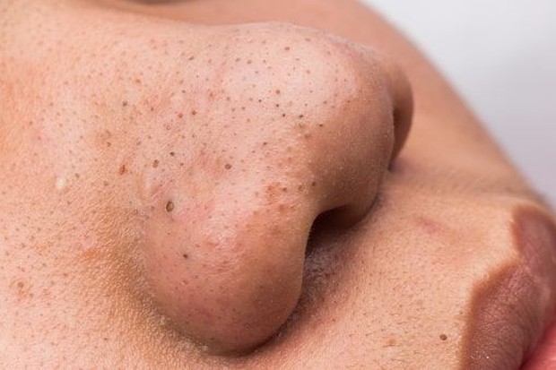 Ilustrasi komedo di hidung/startikel.com
