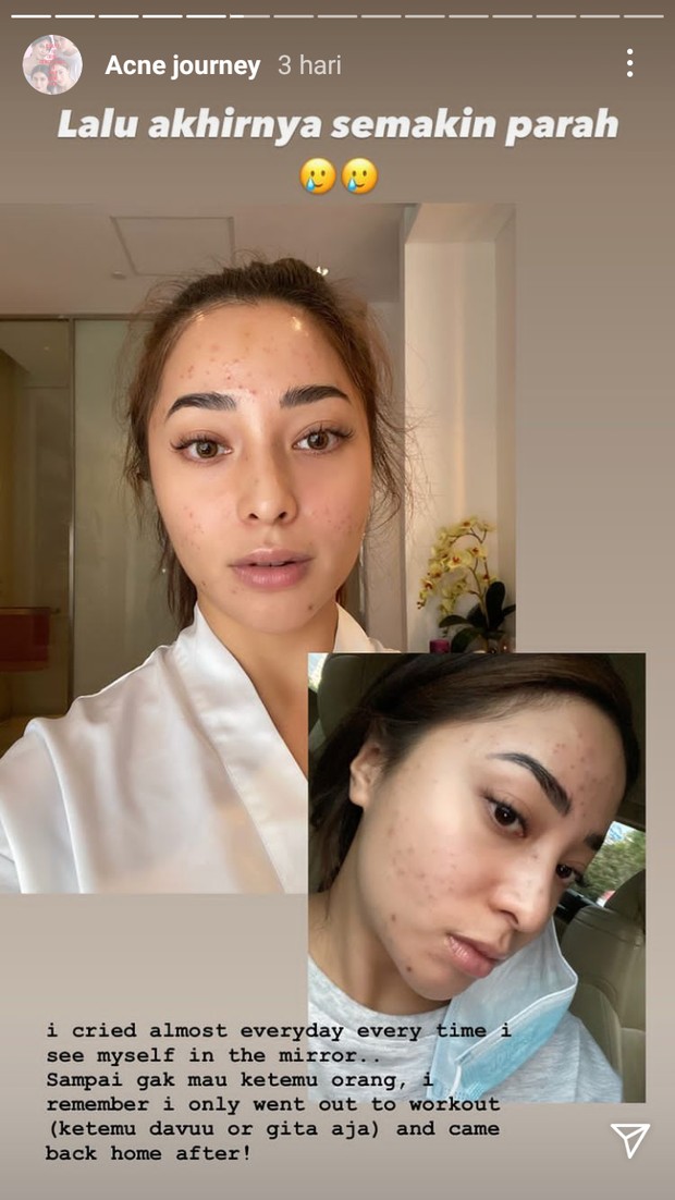 Nikita Willy dengan kondisi wajah breakout/instagram.com/nikitawilly94