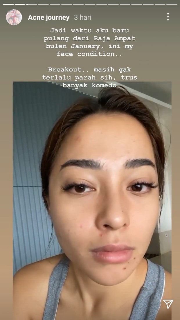 Nikita Willy tunjukkan kondisi wajahnya usai pulang dari Raja Ampat/instagram.com/nikitawilly94