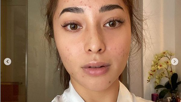 9 Foto Transformasi Wajah Nikita Willy dari Jerawatan Parah Kini Mulus