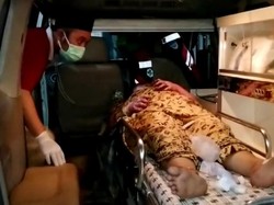 Dibakar Kekasih, Wanita Asal Cianjur Alami Luka Bakar 60 Persen