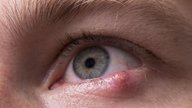 Close up of a man's eye with a stye, bacterial infection of an oil gland in the lower eyelid.