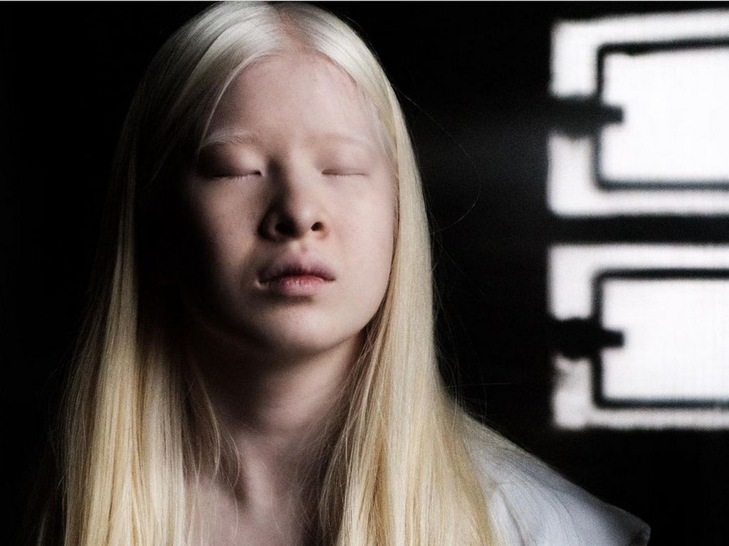 Wanita Albino Ini Dibuang Ortu karena Dianggap Kutukan, Kini Jadi Model Vogue