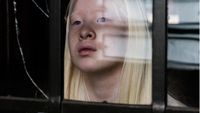 8 Potret Model Albino yang Punya Masa Lalu Kelam, Dibuang Ortu di Panti Asuhan