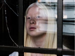 8 Potret Model Albino yang Punya Masa Lalu Kelam, Dibuang Ortu di Panti Asuhan