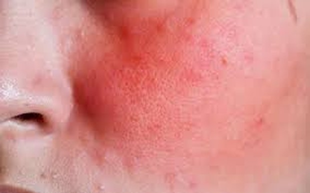 Kulit sensitif langsung terasa efeknya setelah terpapar zat/foto: skinkraft.com Kulit sensitif langsung terasa efeknya setelah terpapar zat