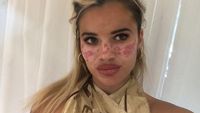 Foto: Wajah Influencer Penuh Bekas Luka, Ikuti Trik Kecantikan di TikTok