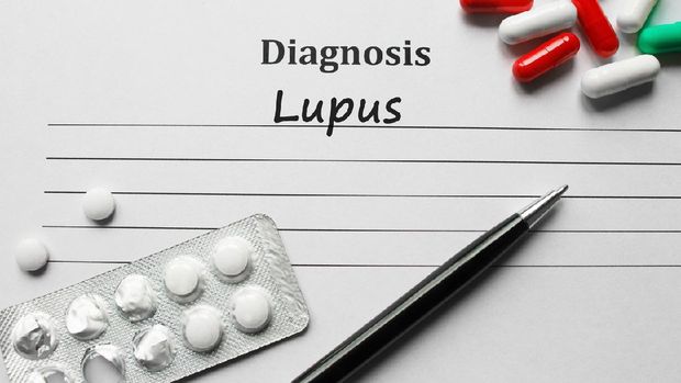 Lupus on the diagnosis list, medical concept