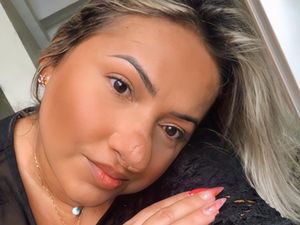 Curhat Wanita yang Idap Kondisi Langka, Sering Diejek Fiona Shrek