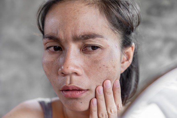 Efek Buruk Sinar UV/sumber: www.freepik.com/ Timbulnya flek hitam akibat sinar UV.