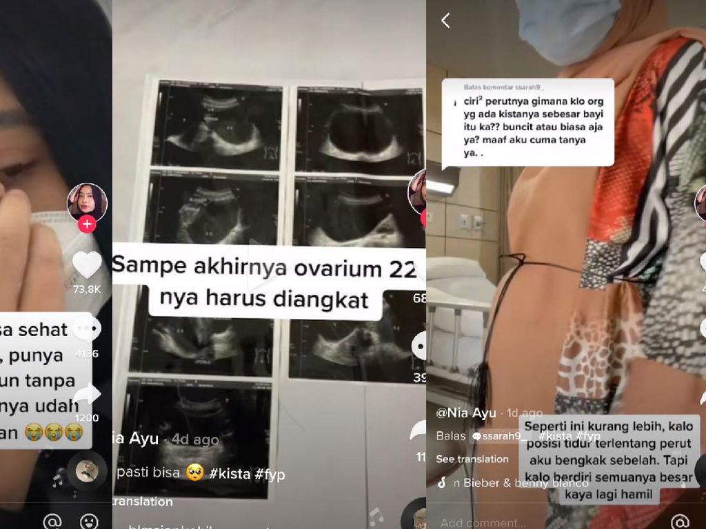 Viral Idap Kista Bak Hamil 6 Bulan, Kedua Ovariumnya Harus Diangkat
