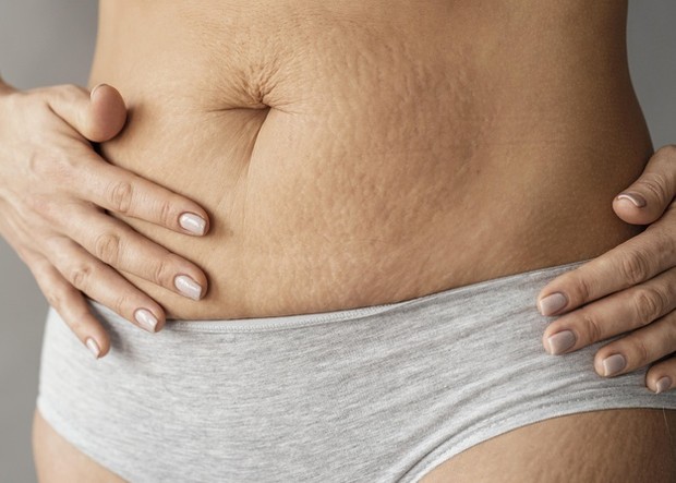 Tidak ada pengobatan topikal yang terbukti untuk menghapus atau mengurangi munculnya stretch mark. Meskipun begitu, tubuh kamu akan tetap indah dengan munculnya stretch mark.