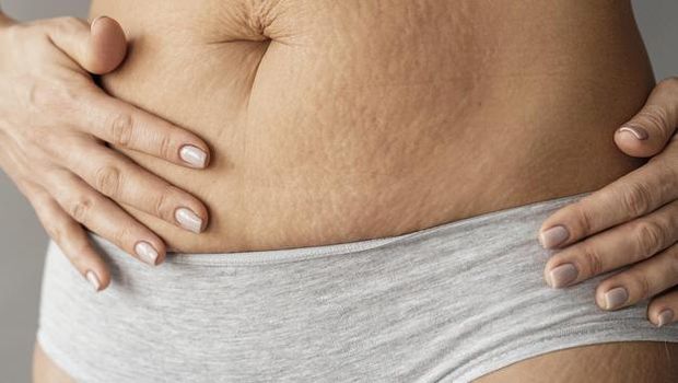 Tidak ada pengobatan topikal yang terbukti untuk menghapus atau mengurangi munculnya stretch mark. Meskipun begitu, tubuh kamu akan tetap indah dengan munculnya stretch mark.