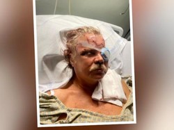 Kepala Luka Parah Digigit Beruang Berkali-kali, Pria Ini Selamat