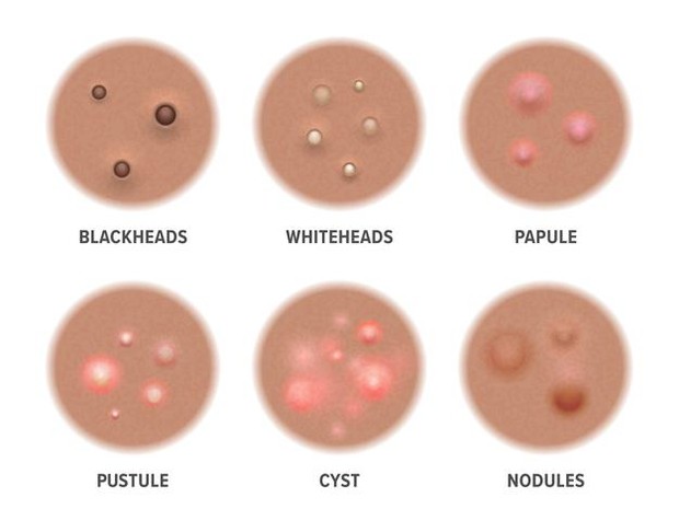 Sesuaikan dengan Kondisi Jerawat