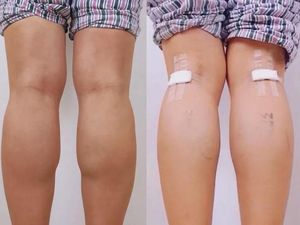 Viral Kontroversi Tren Baru China Putuskan Saraf Kaki Demi Betis Goals