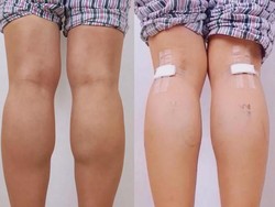 Viral Kontroversi Tren Baru China Putuskan Saraf Kaki Demi Betis Goals