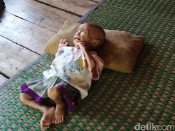 Pilu Balita Gizi Buruk di Cianjur, Kurus Tersisa Kulit dan Tulang