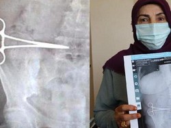 Operasi Tummy Tuck Berujung Bencana, Gunting Tertinggal di Perut Wanita Ini