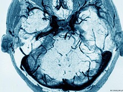 Secercah Harapan Cegah Pembekuan Darah Langka Akibat Vaksin COVID-19