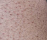 Mengenal Penyakit Kulit Keratosis Pilaris Dan Cara Mengatasinya