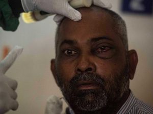 Corona di India Kini Diperparah Penyakit Jamur Putih, Apa Gejalanya?