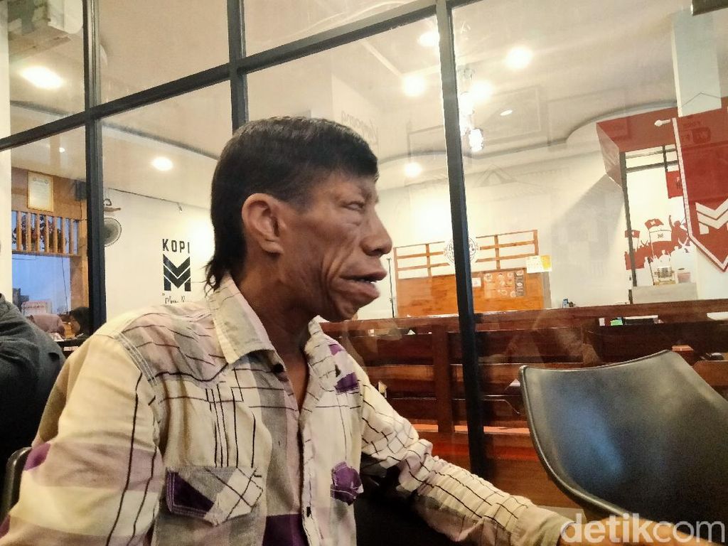Penyebab Treacher Collins Syndrome, Diidap TikToker Viral Surya Manurung Penyebab Treacher Collins Syndrome, Diidap TikToker Viral Surya Manurung