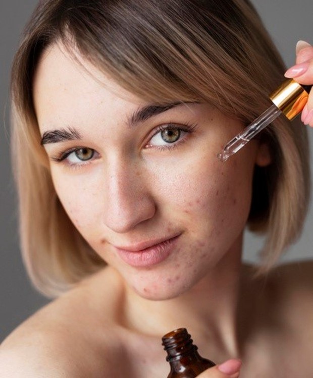 Alasan Timbul Bopeng Setelah Berjerawat