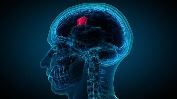 x-ray of brain showing tumor. Computer generated images with correct male anatomy, showing brain with a glowing tumor inside.