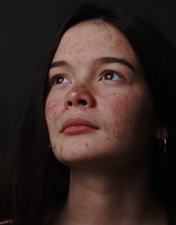 jerawat akibat gula berlebih