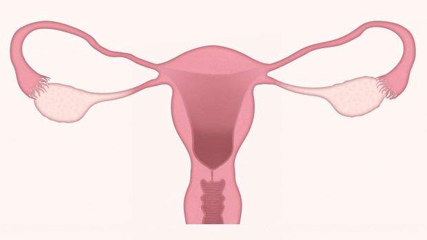 cara mencegah kista ovarium