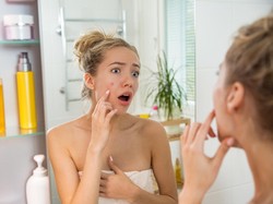 Mengapa Saat Pubertas Rawan Muncul Jerawat? Begini Penjelasannya