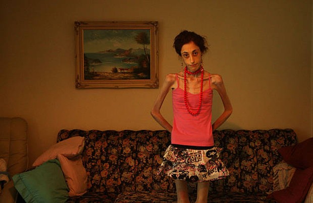 Berlebihan terhadap makanan sehat bisa menimbulkan malnutrisi.