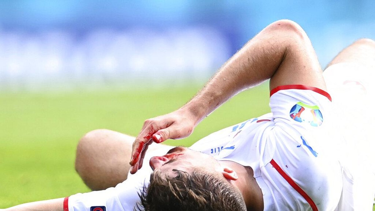 Patrik Schick berdarah-darah dulu, cetak gol penalti kemudian (AP/Paul Ellis)