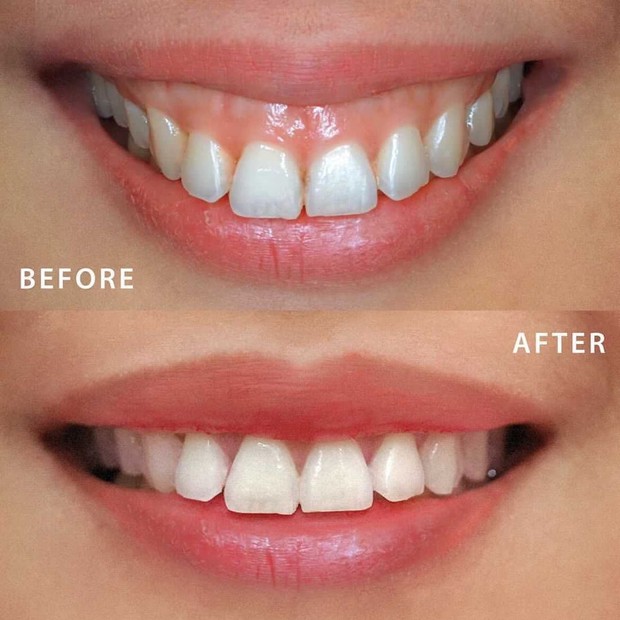 Sebelum dan Sesudah Melakukan Perawatan Gigi/instagram.co/tya_ariestya