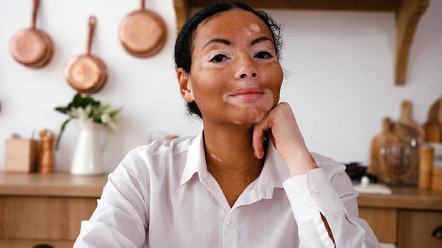 ‘Saya Seorang Vitiligan dan Vitiligo Adalah Keajaiban’