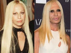 5 Potret Seleb Gagal Oplas, Wajah Cantiknya Malah Berubah Jadi Seperti Ini