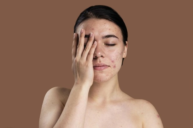 Acne skin (sumber : freepik) Acne skin (sumber : freepik)
