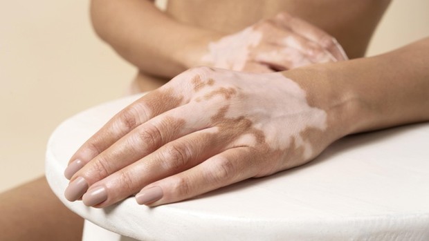 Gejala Vitiligo/Freepik Gejala Vitiligo ditandai dengan munculnya bercak hipopigmentasi pada tubuh.