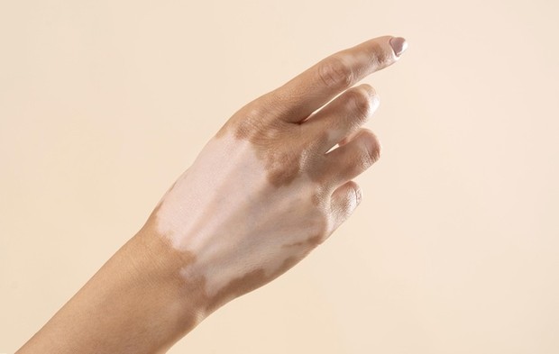 Vitiligo/Freepik Tanning lotion atau penggelap kulit menjadi salah satu pengobatan vitiligo yang bida dilakukan.