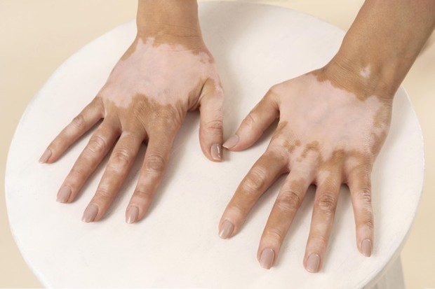 Vitiligo/Freepik Penyakit ini merupakan kondisi hilangnya warna kulit alami yang kemudian menimbulkan area putih seperti susu pada kulit.